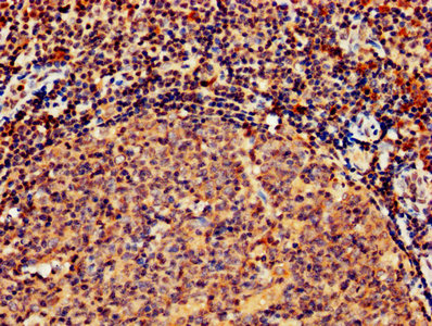 IHC image of the antibody diluted at 1:800 and staining in paraffin-embedded human tonsil tissue performed on a Leica BondTM system. After dewaxing and hydration, antigen retrieval was mediated by high pressure in a citrate buffer (pH 6.0). Section was blocked with 10% normal goat serum 30min at RT. Then primary antibody (1% BSA) was incubated at 4°C overnight. The primary is detected by a biotinylated secondary antibody and visualized using an HRP conjugated SP system.Rabbit anti-Human GZMB Polyclonal Antibody