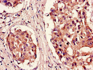 Immunohistochemistry of paraffin-embedded human breast cancer using PSMB5 Antibody at dilution of 1:100Rabbit anti-Human PSMB5 Polyclonal Antibody