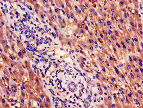 Immunohistochemistry of paraffin-embedded human liver cancer using PSMB5 Antibody at dilution of 1:100Rabbit anti-Human PSMB5 Polyclonal Antibody