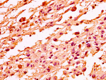 IHC image of H1F0 (Ab-101) Antibody diluted at 1:50 and staining in paraffin-embedded human melanoma performed on a Leica BondTM system. After dewaxing and hydration, antigen retrieval was mediated by high pressure in a citrate buffer (pH 6.0). Section was blocked with 10% normal goat serum 30min at RT. Then primary antibody (1% BSA) was incubated at 4°C overnight. The primary is detected by a biotinylated secondary antibody and visualized using an HRP conjugated SP system.Rabbit anti-Human H1F0 Polyclonal Antibody