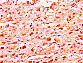 IHC image of the antibody diluted at 1:50 and staining in paraffin-embedded human melanoma performed on a Leica BondTM system. After dewaxing and hydration, antigen retrieval was mediated by high pressure in a citrate buffer (pH 6.0). Section was blocked with 10% normal goat serum 30min at RT. Then primary antibody (1% BSA) was incubated at 4°C overnight. The primary is detected by a biotinylated secondary antibody and visualized using an HRP conjugated SP system.Rabbit anti-Human H1F0 Polyclonal Antibody