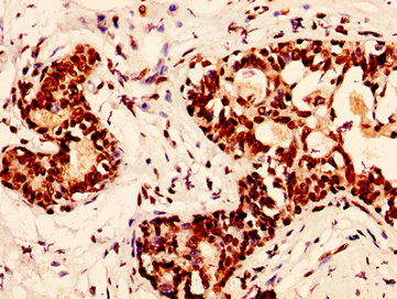 IHC image of H2AFX (Ab-139) Antibody diluted at 1:50 and staining in paraffin-embedded human breast cancer performed on a Leica BondTM system. After dewaxing and hydration, antigen retrieval was mediated by high pressure in a citrate buffer (pH 6.0). Section was blocked with 10% normal goat serum 30min at RT. Then primary antibody (1% BSA) was incubated at 4°C overnight. The primary is detected by a biotinylated secondary antibody and visualized using an HRP conjugated SP system.Rabbit anti-Human H2AFX Polyclonal Antibody