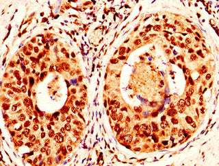 IHC image of H2AFX (Ab-139) Antibody diluted at 1:50 and staining in paraffin-embedded human cervical cancer performed on a Leica BondTM system. After dewaxing and hydration, antigen retrieval was mediated by high pressure in a citrate buffer (pH 6.0). Section was blocked with 10% normal goat serum 30min at RT. Then primary antibody (1% BSA) was incubated at 4°C overnight. The primary is detected by a biotinylated secondary antibody and visualized using an HRP conjugated SP system.Rabbit anti-Human H2AFX Polyclonal Antibody