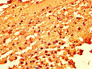 IHC image of H2AFZ (Ab-4) Antibody diluted at 1:50 and staining in paraffin-embedded human melanoma performed on a Leica BondTM system. After dewaxing and hydration, antigen retrieval was mediated by high pressure in a citrate buffer (pH 6.0). Section was blocked with 10% normal goat serum 30min at RT. Then primary antibody (1% BSA) was incubated at 4°C overnight. The primary is detected by a biotinylated secondary antibody and visualized using an HRP conjugated SP system.Rabbit anti-Human H2AFZ Polyclonal Antibody