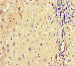 Immunohistochemistry of paraffin-embedded human liver cancer using H3F3A Antibody at dilution of 1:100Rabbit anti-Human H3F3A Polyclonal Antibody