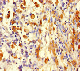Immunohistochemistry of paraffin-embedded human melanoma using H3F3A Antibody at dilution of 1:100Rabbit anti-Human H3F3A Polyclonal Antibody