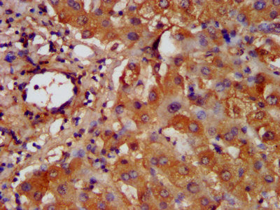 IHC image of the antibody diluted at 1:200 and staining in paraffin-embedded human liver tissue performed on a Leica BondTM system. After dewaxing and hydration, antigen retrieval was mediated by high pressure in a citrate buffer (pH 6.0). Section was blocked with 10% normal goat serum 30min at RT. Then primary antibody (1% BSA) was incubated at 4°C overnight. The primary is detected by a biotinylated secondary antibody and visualized using an HRP conjugated SP system.Rabbit anti-Human HAL Polyclonal Antibody