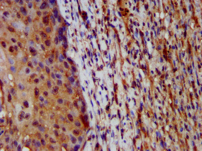 IHC image of HAL Antibody diluted at 1:200 and staining in paraffin-embedded human lung cancer performed on a Leica BondTM system. After dewaxing and hydration, antigen retrieval was mediated by high pressure in a citrate buffer (pH 6.0). Section was blocked with 10% normal goat serum 30min at RT. Then primary antibody (1% BSA) was incubated at 4°C overnight. The primary is detected by a biotinylated secondary antibody and visualized using an HRP conjugated SP system.Rabbit anti-Human HAL Polyclonal Antibody