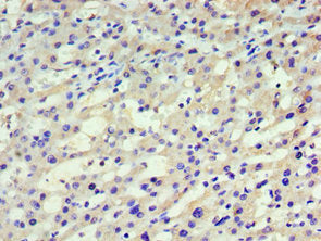 Immunohistochemistry of paraffin-embedded human liver cancer using HARS Antibody at dilution of 1:100Rabbit anti-Human HARS Polyclonal Antibody