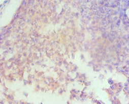 Immunohistochemistry of paraffin-embedded human cervical cancer using HAS3 Antibody at dilution of 1:100Rabbit anti-Human HAS3 Polyclonal Antibody