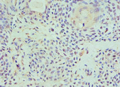 Immunohistochemistry of paraffin-embedded human breast cancer using HAT1 Antibody at dilution of 1:100Rabbit anti-Human HAT1 Polyclonal Antibody