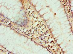 Immunohistochemistry of paraffin-embedded human colon cancer using HAT1 Antibody at dilution of 1:100Rabbit anti-Human HAT1 Polyclonal Antibody