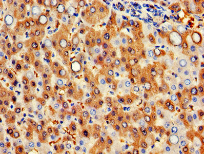 IHC image of HBB Antibody diluted at 1:300 and staining in paraffin-embedded human liver cancer performed on a Leica BondTM system. After dewaxing and hydration, antigen retrieval was mediated by high pressure in a citrate buffer (pH 6.0). Section was blocked with 10% normal goat serum 30min at RT. Then primary antibody (1% BSA) was incubated at 4°C overnight. The primary is detected by a biotinylated secondary antibody and visualized using an HRP conjugated SP system.Rabbit anti-Human HBB Polyclonal Antibody