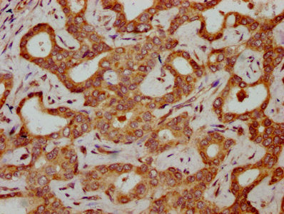 IHC image of HBG2 Antibody diluted at 1:300 and staining in paraffin-embedded human liver cancer performed on a Leica BondTM system. After dewaxing and hydration, antigen retrieval was mediated by high pressure in a citrate buffer (pH 6.0). Section was blocked with 10% normal goat serum 30min at RT. Then primary antibody (1% BSA) was incubated at 4°C overnight. The primary is detected by a biotinylated secondary antibody and visualized using an HRP conjugated SP system.Rabbit anti-Human HBG2 Polyclonal Antibody