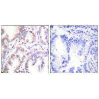 Immunohistochemistry analysis of paraffin-embedded human lung carcinoma tissue using CDK7 antibody.Rabbit anti-Human CDK7 Polyclonal Antibody