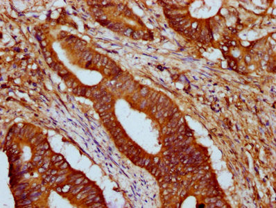 IHC image of the antibody diluted at 1:500 and staining in paraffin-embedded human colon cancer performed on a Leica BondTM system. After dewaxing and hydration, antigen retrieval was mediated by high pressure in a citrate buffer (pH 6.0). Section was blocked with 10% normal goat serum 30min at RT. Then primary antibody (1% BSA) was incubated at 4°C overnight. The primary is detected by a biotinylated secondary antibody and visualized using an HRP conjugated SP system.Rabbit anti-Human HCN1 Polyclonal Antibody