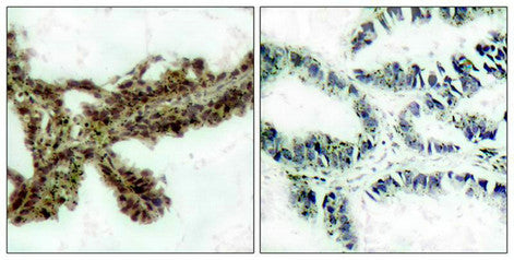 Immunohistochemical analysis of paraffin-embedded human lung carcinoma tissue, using Akt (Phospho-Thr308) Antibody (left) or the same antibody preincubated with blocking peptide (right).Rabbit anti-Human AKT1 Polyclonal Antibody