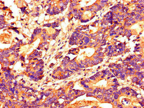 Immunohistochemistry of paraffin-embedded human colon cancer using HDAC10 Antibody at dilution of 1:100Rabbit anti-Human HDAC10 Polyclonal Antibody