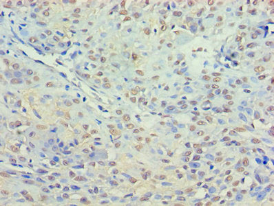 Immunohistochemistry of paraffin-embedded human breast cancer using HDAC3 Antibody at dilution of 1:100Rabbit anti-Human HDAC3 Polyclonal Antibody