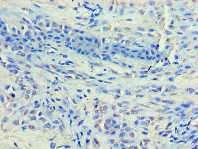 Immunohistochemistry of paraffin-embedded human breast cancer using HDAC8 Antibody at dilution of 1:100Rabbit anti-Human HDAC8 Polyclonal Antibody