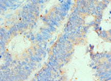 Immunohistochemistry of paraffin-embedded human colon cancer using HIP1 Antibody at dilution of 1:100Rabbit anti-Human HIP1 Polyclonal Antibody
