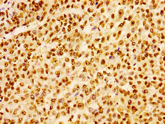 Immunohistochemistry of paraffin-embedded human colon cancer using HIST1H1B (Ab-16) Antibody at dilution of 1:100Rabbit anti-Human HIST1H1B Polyclonal Antibody