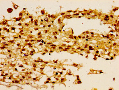 Immunohistochemistry of paraffin-embedded human melanoma using HIST1H1B (Ab-16) Antibody at dilution of 1:100Rabbit anti-Human HIST1H1B Polyclonal Antibody