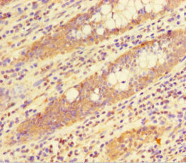 Immunohistochemistry of paraffin-embedded human colon cancer using the antibody at dilution of 1:100Rabbit anti-Human HIST1H1C Polyclonal Antibody