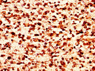 IHC image of HIST1H1C (Ab-109) Antibody diluted at 1:50 and staining in paraffin-embedded human glioma performed on a Leica BondTM system. After dewaxing and hydration, antigen retrieval was mediated by high pressure in a citrate buffer (pH 6.0). Section was blocked with 10% normal goat serum 30min at RT. Then primary antibody (1% BSA) was incubated at 4°C overnight. The primary is detected by a biotinylated secondary antibody and visualized using an HRP conjugated SP system.Rabbit anti-Human HIST1H1C Polyclonal Antibody