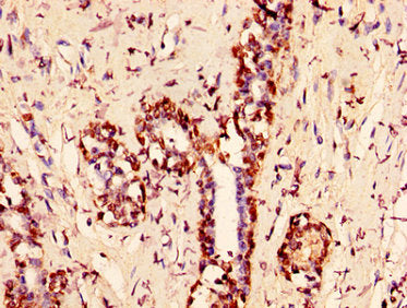 IHC image of HIST1H1C (Ab-109) Antibody diluted at 1:50 and staining in paraffin-embedded human breast cancer performed on a Leica BondTM system. After dewaxing and hydration, antigen retrieval was mediated by high pressure in a citrate buffer (pH 6.0). Section was blocked with 10% normal goat serum 30min at RT. Then primary antibody (1% BSA) was incubated at 4°C overnight. The primary is detected by a biotinylated secondary antibody and visualized using an HRP conjugated SP system.Rabbit anti-Human HIST1H1C Polyclonal Antibody