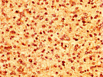 IHC image of HIST1H1C (Ab-164) Antibody diluted at 1:50 and staining in paraffin-embedded human glioma performed on a Leica BondTM system. After dewaxing and hydration, antigen retrieval was mediated by high pressure in a citrate buffer (pH 6.0). Section was blocked with 10% normal goat serum 30min at RT. Then primary antibody (1% BSA) was incubated at 4°C overnight. The primary is detected by a biotinylated secondary antibody and visualized using an HRP conjugated SP system.Rabbit anti-Human HIST1H1C Polyclonal Antibody