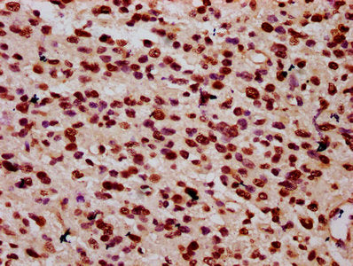 IHC image of HIST1H1C (Ab-25) Antibody diluted at 1:10 and staining in paraffin-embedded human glioma performed on a Leica BondTM system. After dewaxing and hydration, antigen retrieval was mediated by high pressure in a citrate buffer (pH 6.0). Section was blocked with 10% normal goat serum 30min at RT. Then primary antibody (1% BSA) was incubated at 4°C overnight. The primary is detected by a biotinylated secondary antibody and visualized using an HRP conjugated SP system.Rabbit anti-Human HIST1H1C Polyclonal Antibody
