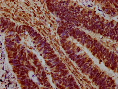 IHC image of the antibody diluted at 1:20 and staining in paraffin-embedded human ovarian cancer performed on a Leica BondTM system. After dewaxing and hydration, antigen retrieval was mediated by high pressure in a citrate buffer (pH 6.0). Section was blocked with 10% normal goat serum 30min at RT. Then primary antibody (1% BSA) was incubated at 4°C overnight. The primary is detected by a biotinylated secondary antibody and visualized using an HRP conjugated SP system.Rabbit anti-Human HIST1H1C Polyclonal Antibody