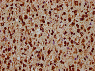 IHC image of HIST1H1C (Ab-45) Antibody diluted at 1:20 and staining in paraffin-embedded human glioma performed on a Leica BondTM system. After dewaxing and hydration, antigen retrieval was mediated by high pressure in a citrate buffer (pH 6.0). Section was blocked with 10% normal goat serum 30min at RT. Then primary antibody (1% BSA) was incubated at 4°C overnight. The primary is detected by a biotinylated secondary antibody and visualized using an HRP conjugated SP system.Rabbit anti-Human HIST1H1C Polyclonal Antibody