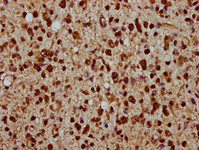 IHC image of HIST1H1C (Ab-45) Antibody diluted at 1:20 and staining in paraffin-embedded human glioma performed on a Leica BondTM system. After dewaxing and hydration, antigen retrieval was mediated by high pressure in a citrate buffer (pH 6.0). Section was blocked with 10% normal goat serum 30min at RT. Then primary antibody (1% BSA) was incubated at 4°C overnight. The primary is detected by a biotinylated secondary antibody and visualized using an HRP conjugated SP system.Rabbit anti-Human HIST1H1C Polyclonal Antibody