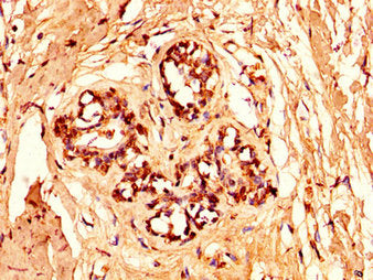 IHC image of the antibody diluted at 1:50 and staining in paraffin-embedded human breast cancer performed on a Leica BondTM system. After dewaxing and hydration, antigen retrieval was mediated by high pressure in a citrate buffer (pH 6.0). Section was blocked with 10% normal goat serum 30min at RT. Then primary antibody (1% BSA) was incubated at 4°C overnight. The primary is detected by a biotinylated secondary antibody and visualized using an HRP conjugated SP system.Rabbit anti-Human HIST1H1C Polyclonal Antibody