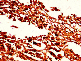 IHC image of HIST1H1C (Ab-96) Antibody diluted at 1:50 and staining in paraffin-embedded human melanoma performed on a Leica BondTM system. After dewaxing and hydration, antigen retrieval was mediated by high pressure in a citrate buffer (pH 6.0). Section was blocked with 10% normal goat serum 30min at RT. Then primary antibody (1% BSA) was incubated at 4°C overnight. The primary is detected by a biotinylated secondary antibody and visualized using an HRP conjugated SP system.Rabbit anti-Human HIST1H1C Polyclonal Antibody