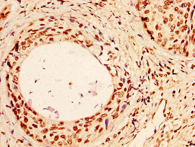 IHC image of the antibody diluted at 1:50 and staining in paraffin-embedded human cervical cancer performed on a Leica BondTM system. After dewaxing and hydration, antigen retrieval was mediated by high pressure in a citrate buffer (pH 6.0). Section was blocked with 10% normal goat serum 30min at RT. Then primary antibody (1% BSA) was incubated at 4°C overnight. The primary is detected by a biotinylated secondary antibody and visualized using an HRP conjugated SP system.Rabbit anti-Human HIST1H1C Polyclonal Antibody