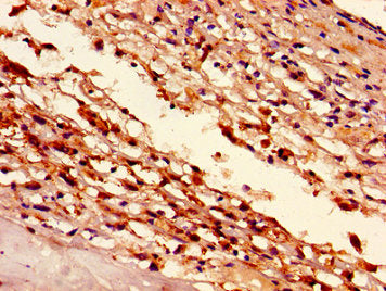 Immunohistochemistry of paraffin-embedded human melanoma using HIST1H1D (Ab-140) Antibody at dilution of 1:100Rabbit anti-Human HIST1H1D Polyclonal Antibody