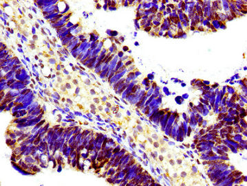 Immunohistochemistry of paraffin-embedded human ovarian cancer using HIST1H1D (Ab-146) Antibody at dilution of 1:100Rabbit anti-Human HIST1H1D Polyclonal Antibody