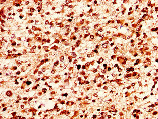 IHC image of HIST1H1E (Ab-17) Antibody diluted at 1:50 and staining in paraffin-embedded human glioma performed on a Leica BondTM system. After dewaxing and hydration, antigen retrieval was mediated by high pressure in a citrate buffer (pH 6.0). Section was blocked with 10% normal goat serum 30min at RT. Then primary antibody (1% BSA) was incubated at 4°C overnight. The primary is detected by a biotinylated secondary antibody and visualized using an HRP conjugated SP system.Rabbit anti-Human HIST1H1E Polyclonal Antibody