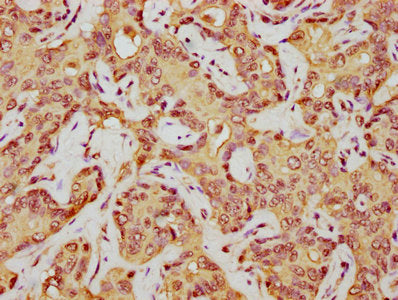 IHC image of HIST1H1E (Ab-45) Antibody diluted at 1:5 and staining in paraffin-embedded human liver cancer performed on a Leica BondTM system. After dewaxing and hydration, antigen retrieval was mediated by high pressure in a citrate buffer (pH 6.0). Section was blocked with 10% normal goat serum 30min at RT. Then primary antibody (1% BSA) was incubated at 4°C overnight. The primary is detected by a biotinylated secondary antibody and visualized using an HRP conjugated SP system.Rabbit anti-Human HIST1H1E Polyclonal Antibody