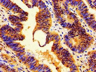Immunohistochemistry of paraffin-embedded human colon cancer using HIST1H1E (Ab-3) Antibody at dilution of 1:100Rabbit anti-Human HIST1H1E Polyclonal Antibody