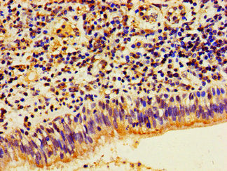 Immunohistochemistry of paraffin-embedded human lung cancer using HIST1H1E (Ab-16) Antibody at dilution of 1:100Rabbit anti-Human HIST1H1E Polyclonal Antibody