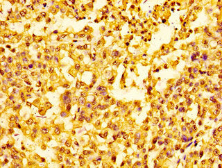 Immunohistochemistry of paraffin-embedded human colon cancer using HIST1H1E (Ab-25) Antibody at dilution of 1:100Rabbit anti-Human HIST1H1E Polyclonal Antibody