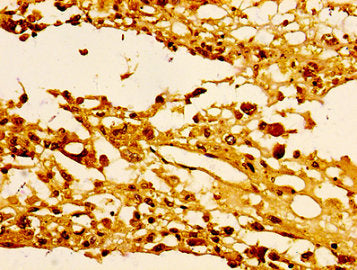 Immunohistochemistry of paraffin-embedded human melanoma using HIST1H1E (Ab-25) Antibody at dilution of 1:100Rabbit anti-Human HIST1H1E Polyclonal Antibody