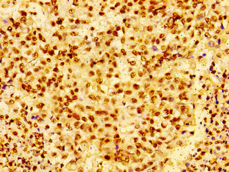 Immunohistochemistry of paraffin-embedded human colon cancer using HIST1H1E (Ab-26) Antibody at dilution of 1:100Rabbit anti-Human HIST1H1E Polyclonal Antibody