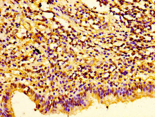 Immunohistochemistry of paraffin-embedded human lung cancer using HIST1H1E (Ab-26) Antibody at dilution of 1:100Rabbit anti-Human HIST1H1E Polyclonal Antibody