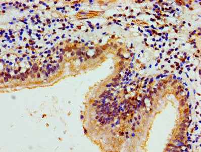 Immunohistochemistry of paraffin-embedded human lung cancer using HIST1H1E (Ab-33) Antibody at dilution of 1:100Rabbit anti-Human HIST1H1E Polyclonal Antibody