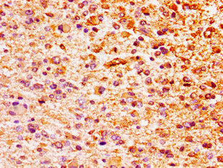 Immunohistochemistry of paraffin-embedded human glioma using HIST1H1E (Ab-62) Antibody at dilution of 1:100Rabbit anti-Human HIST1H1E Polyclonal Antibody
